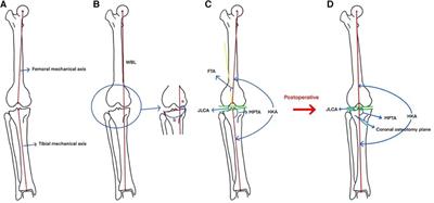 Early results of high tibial osteotomy versus combined arthroscopic surgery